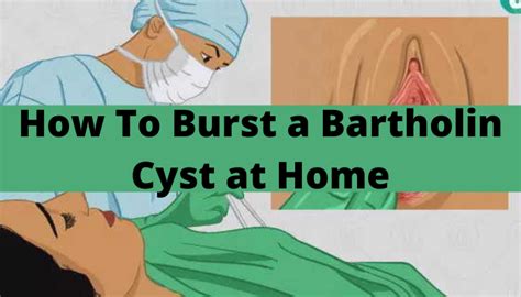 How To Burst A Bartholin Cyst At Home Techvtimes