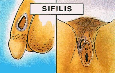 A menudo no presenta ningún síntoma. SIFILIS | marcos816