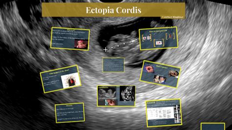 Ectopia Cordis By Courtney Ringhiser