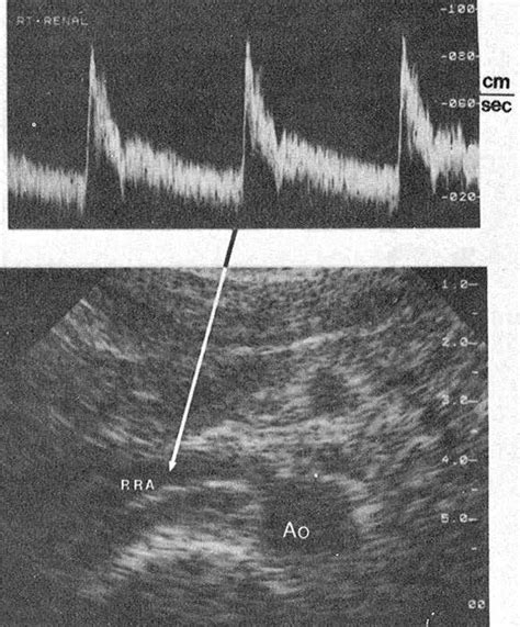 Duplex Ultrasound Scanning In The Diagnosis Of Renal Artery Stenosis A