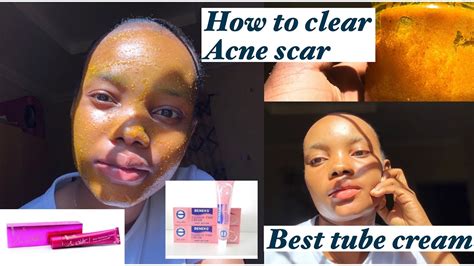 How To Get Rid Of Dark Spot And Hyperpigmentation Best Tube Creams