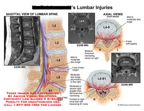 lumbar injuries