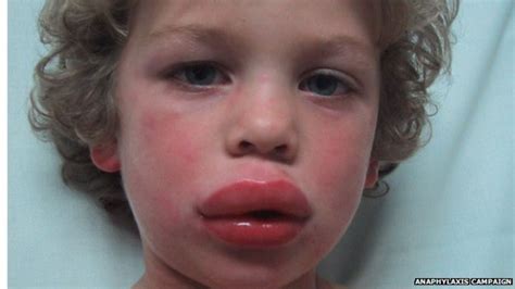 A sudden, usually systemic allergic reaction, characterized by vasodilation resulting in decreased blood pressure, smoot. Q&A: Anaphylaxis - severe allergic reactions explained ...