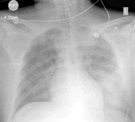 Post Intubation Chest X Ray Demonstrating Diffuse Bilateral Alveolar