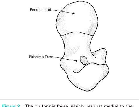 Figure 4 From Piriformis Fossa Approach In Optimising Femoral Neck