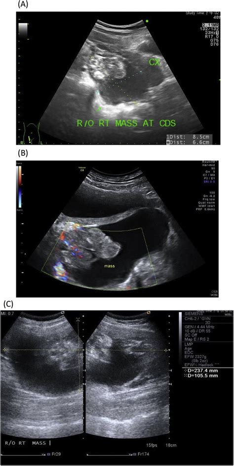 Antepartum Ultrasonography Revealed A Well Defined Hyperechoic Mass