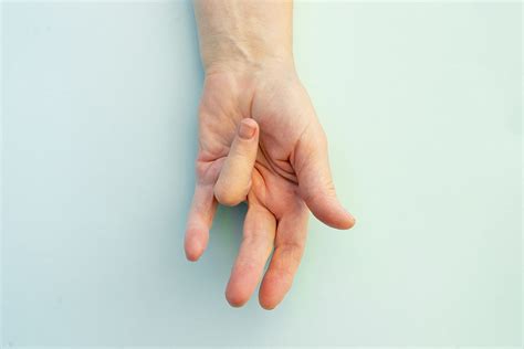 Dupuytren Contracture Causes Symptoms And Treatment Andrea D Schroder