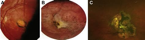 North Carolina Macular Dystrophy Long Term Follow Up Of The Original