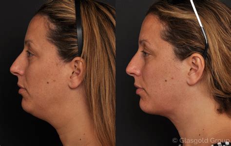 What Is A Neck Lift
