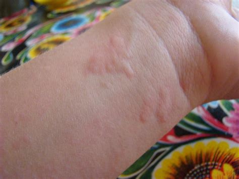 Hives What Causes Them How To Make Them Go Away Dr Leslie