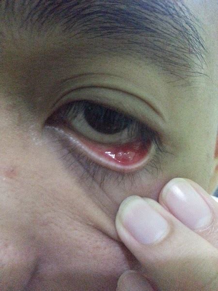 8 penyebab mata gatal dan cara mengatasinya. Segera Obati Mata Bintitan!! | Ridwansyah Corner