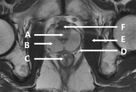 Axial T2 Weighted Magnetic Resonance Imaging Of The Male Pelvis The Bmj