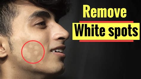 Get Rid Of White Spots On Face How To Remove White Spots From Face