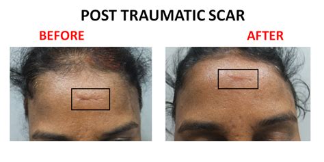 Laser Scar Removal Amrit Clinic