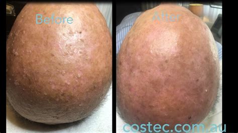 Solar Keratosis Treatment