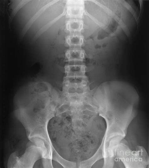 Lumbar And Pelvic X Ray Photograph By Ted Kinsman Pixels