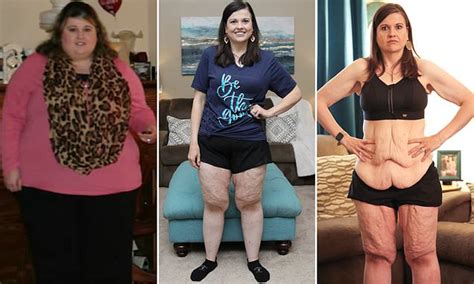 woman who once tipped scales at 420lbs reveals she s waiting to remove 20lbs of excess skin