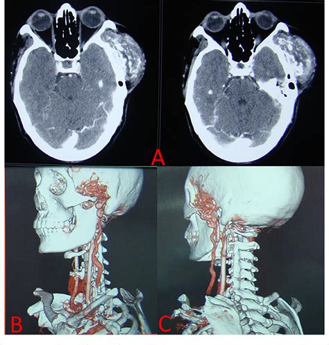 Figure 1 From Surgical Management Of Scalp Arteriovenous Malformations