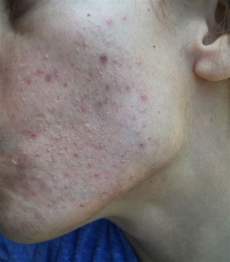 Please Help Lots Of Small Bumps All Over Cheeks General Acne