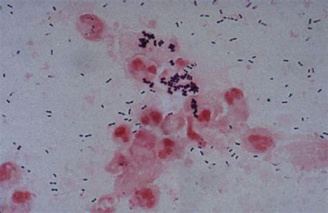 Sputum Smear Staphylococcus And Streptococcus Pneumoniae Dr Tadayo