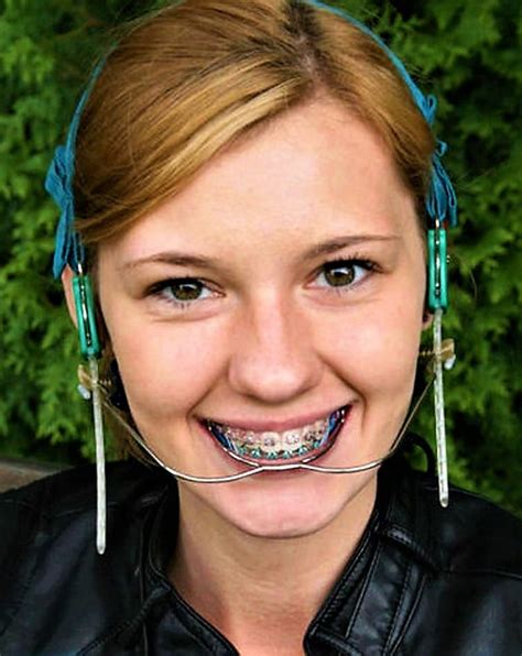 Pin By Randal Tucker On Orthodontic Headgear Braces Braces Girls Dental Braces Headgear