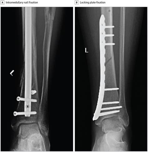 Locking Plate Vs Intramedullary Nail Fixation And Disability In Tibia
