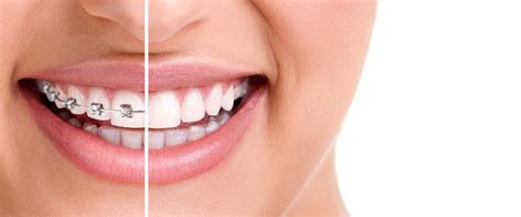 White Spots After Braces Learn How Cosmetic Dentistry Can Help