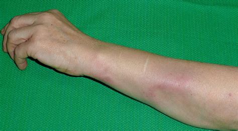 Case Report On A Patient With Lupus Panniculitis Abstract Europe Pmc