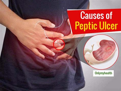 Peptic Ulcer Causes Symptoms And Treatment Peptic Ulcer Causes Hot Sex Picture