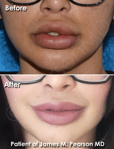 lip reduction photos before and after dr james pearson facial plastic surgery