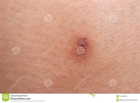 Lesion On Arm Skin Begin Scab Dried On The Epidermis Stock Photo