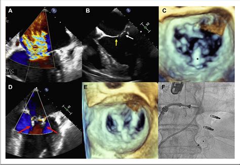 Figure 2 From Combined Transcatheter Treatment Of Ventricular Septal