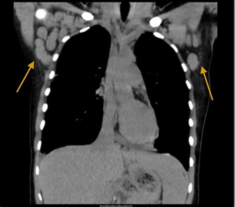 Ct Scan Of Chest Showing Bilateral Enlarged Axillary