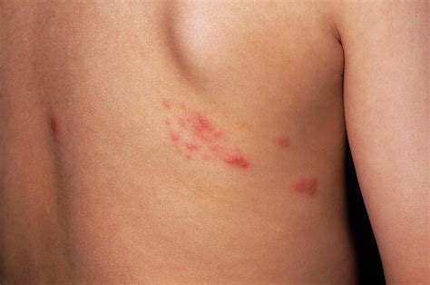 skin rash on torso and back