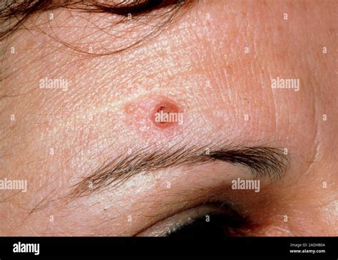 Basal Cell Carcinoma Close Up Of A Womans Forehead Showing A Basal