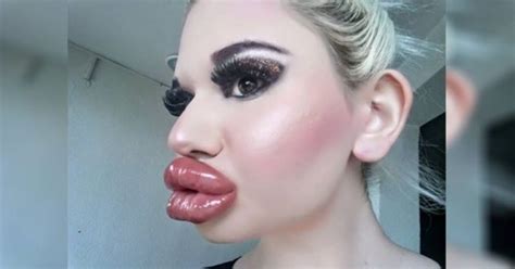 A Real Life Barbie Goes Overboard With Lip Filler Injections Innerstrengthzone Com