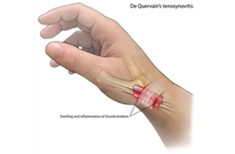 De Quervains Tenosynovitis Hot Sex Picture