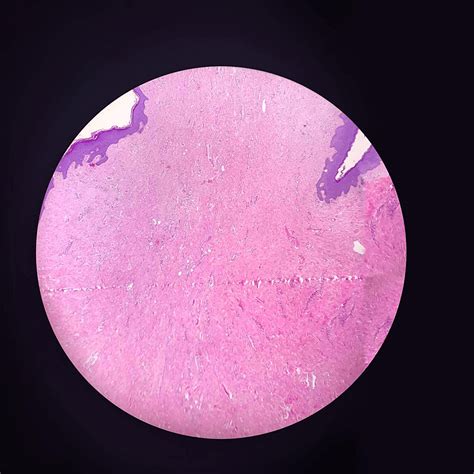 Cureus A Giant Fibroepithelial Polyp Of The Vulva