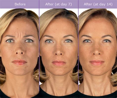 Understanding Injectables And Dermal Fillers Botox And Juvederm In