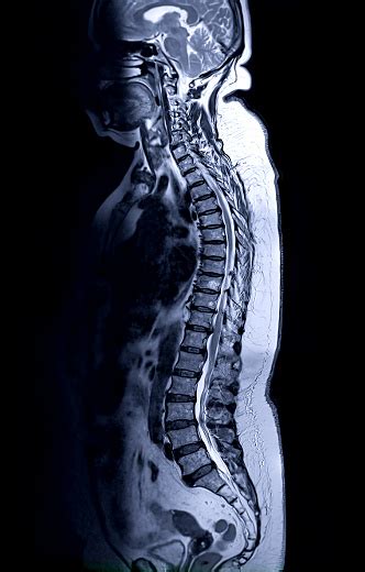 Mri Whole Spine Screening For Diagnosis Spinal Cord Compression Stock