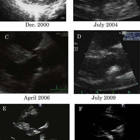 Patterns Of Aortic Sclerosis Seen On Echocardiography Diffuse A And