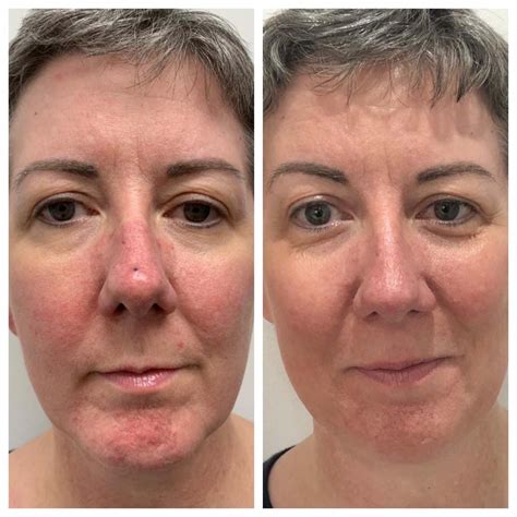 Wowo Fusion Rosacea Before And After Photo Cosmetic Treatments In