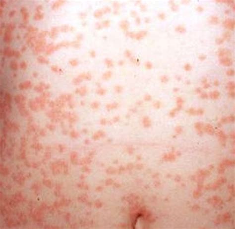 Guttate Psoriasis Pictures Treatment Symptoms Causes Home Remedies