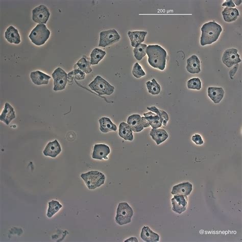 Lista Foto Celulas Epiteliales No Escamosas En Orina Alta Definición Completa k k