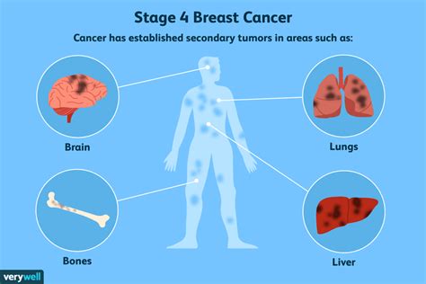 Breast Cancer Spread To The Brain—symptoms And Treatments