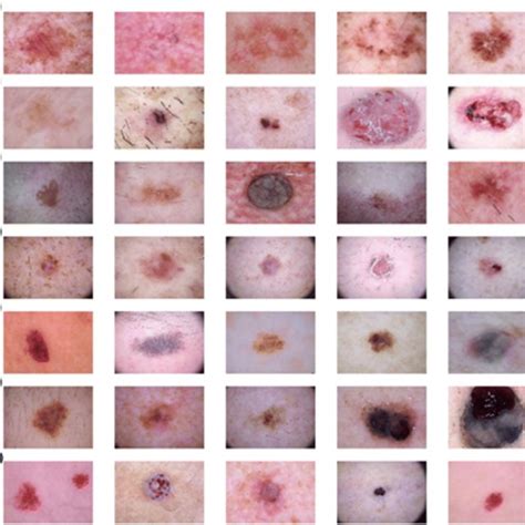 Sample Skin Cancer Images From Ham10000 Dataset A Actinic Keratosis