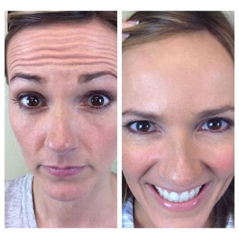 How long does/did/will it take to do something? What Is Botox, Its Benefits And Side Effects | Fabbon