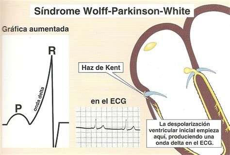 Sindrome De Wolff Parkinson White Eletrocardiograma