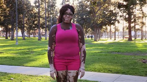 Skin Condition Leaves Woman With Two Skin Colors Body Bizarre