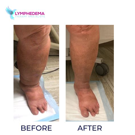Lymphedema Treatment Before And After